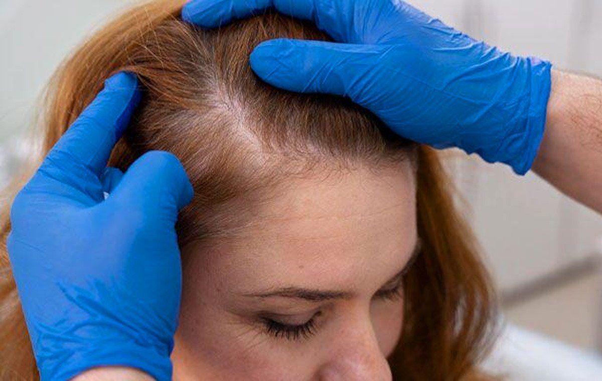 علائم ریزش مو در زنان