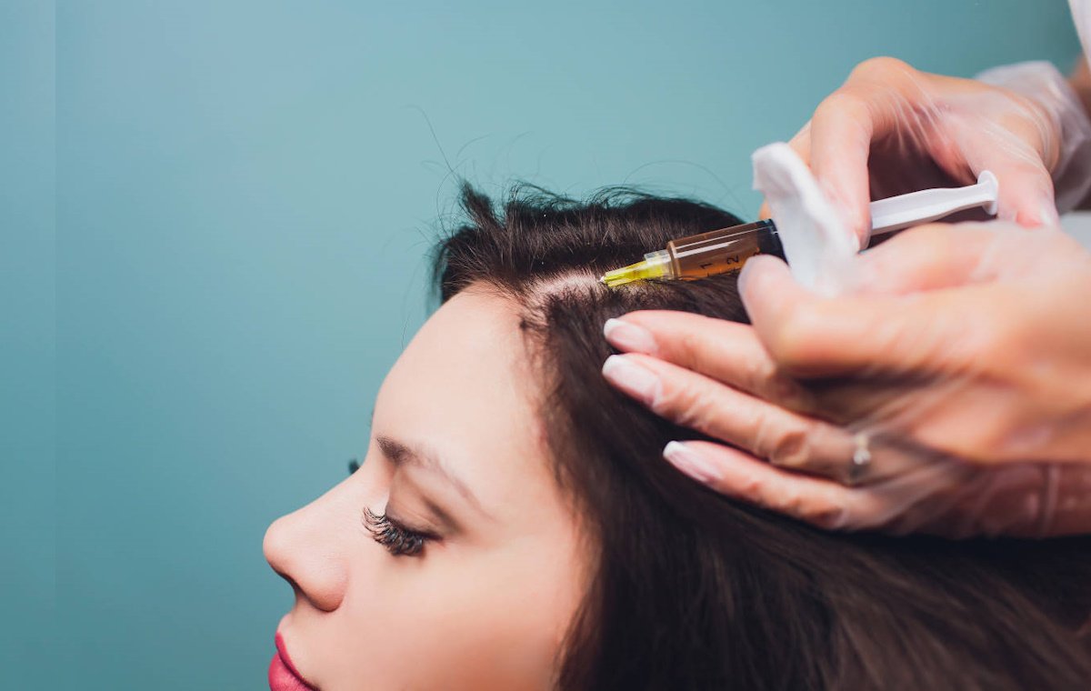 درمان ریزش مو در زنان با روش PRP