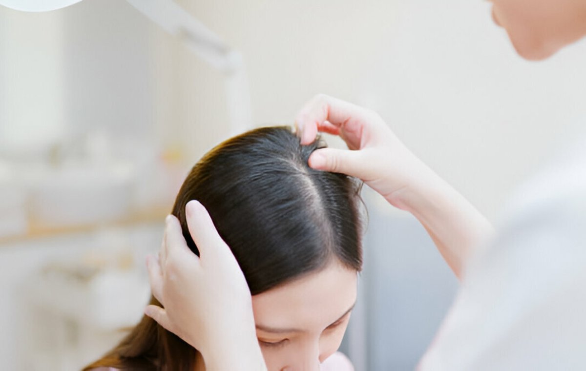 تشخیص ریزش موی هورمونی توسط پزشک
