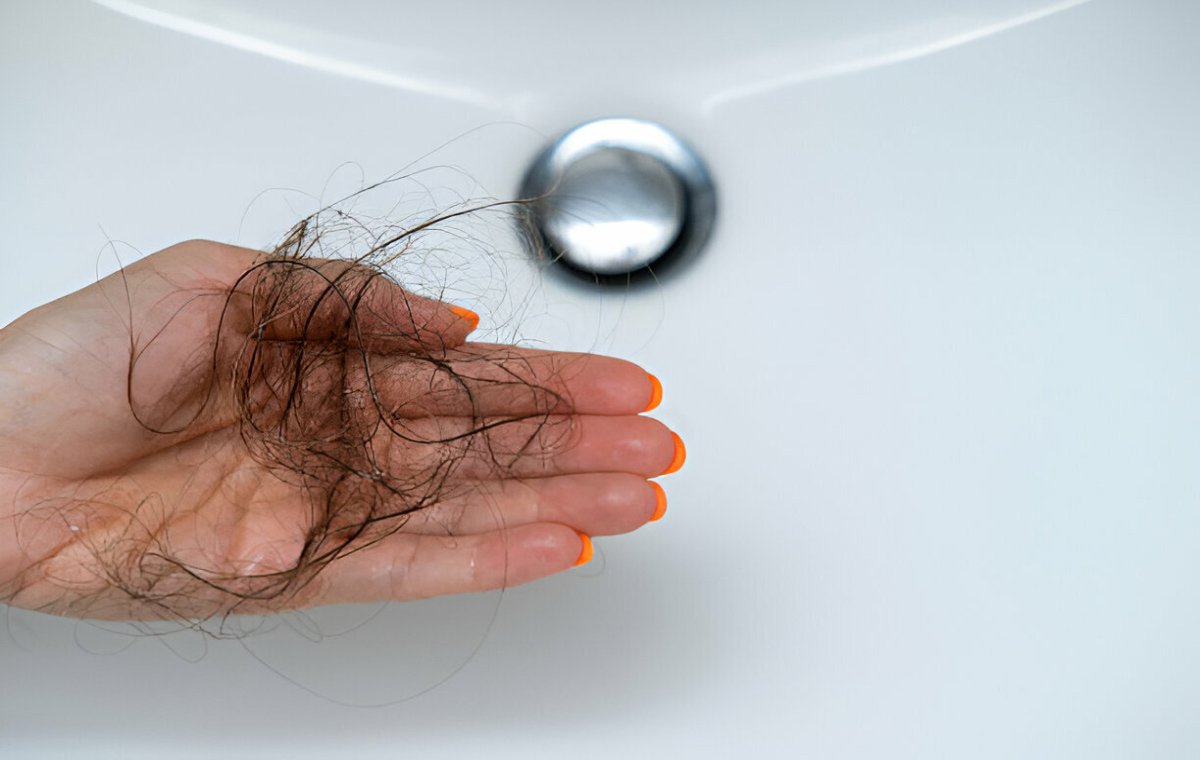 ریزش موی هورمونی در بزرگسالان