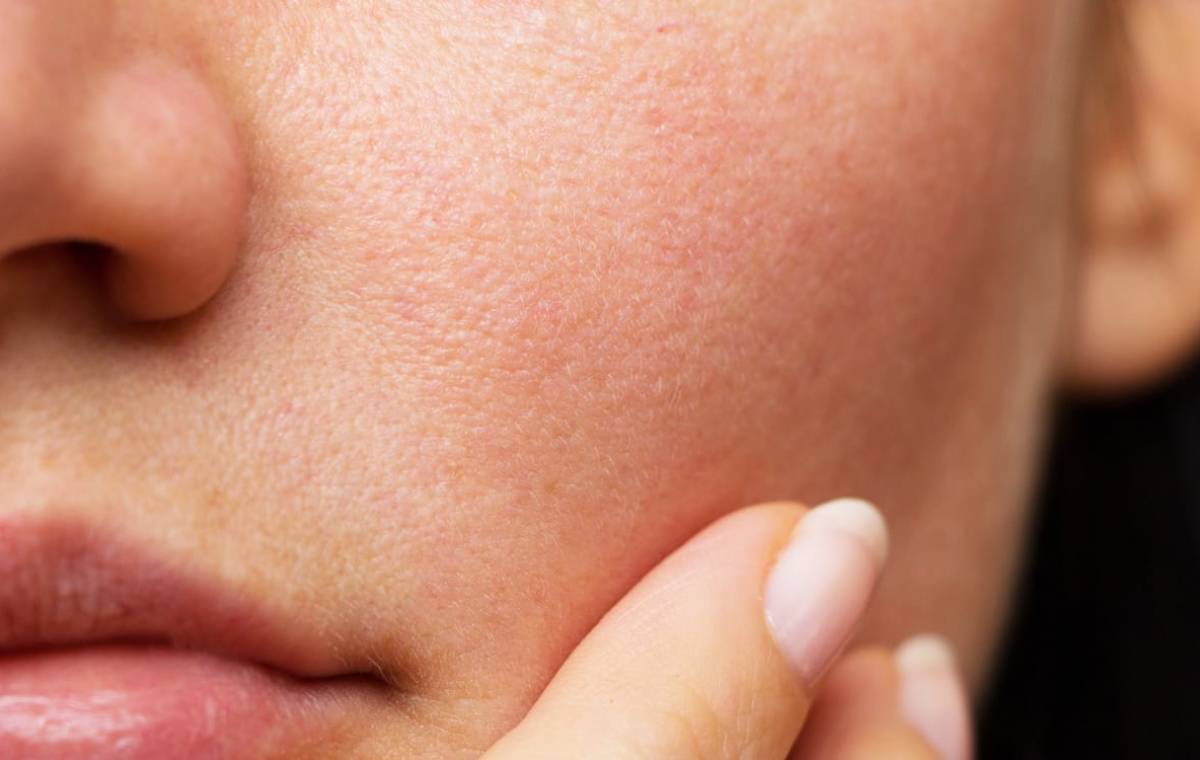 آنچه باید در مورد لایه‌ی اپیدرم پوست خود بدانید