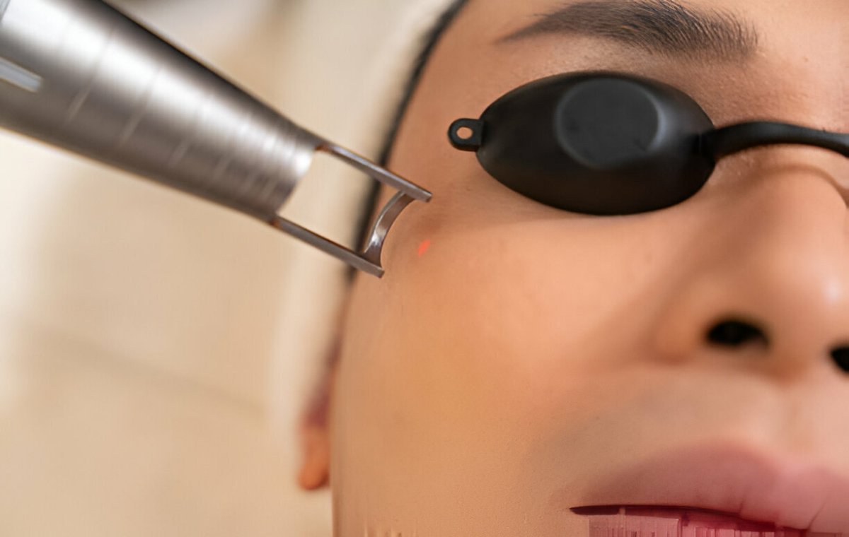 درمان علت تیرگی پوست صورت با لیزر