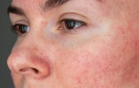 بیماری پوستی روزاسه چیست و چطور درمان می‌شود؟
