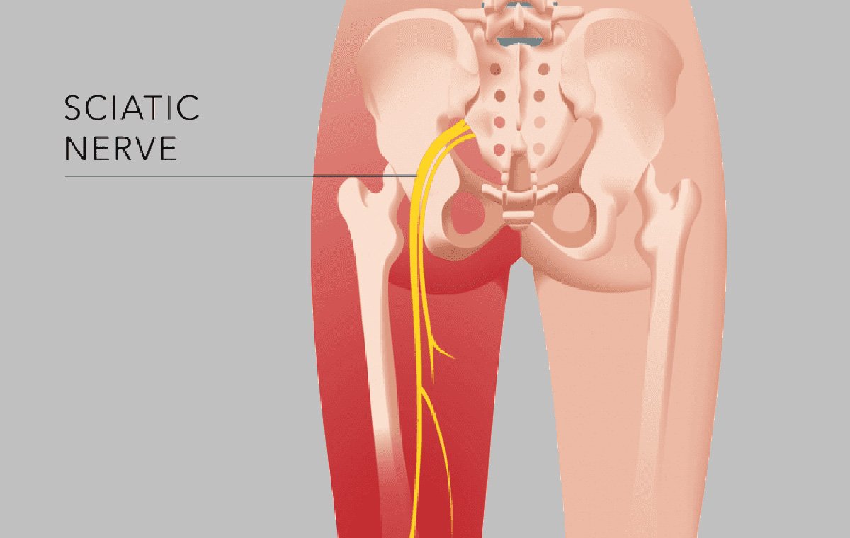 درمان درد سیاتیک پای چپ در خانه