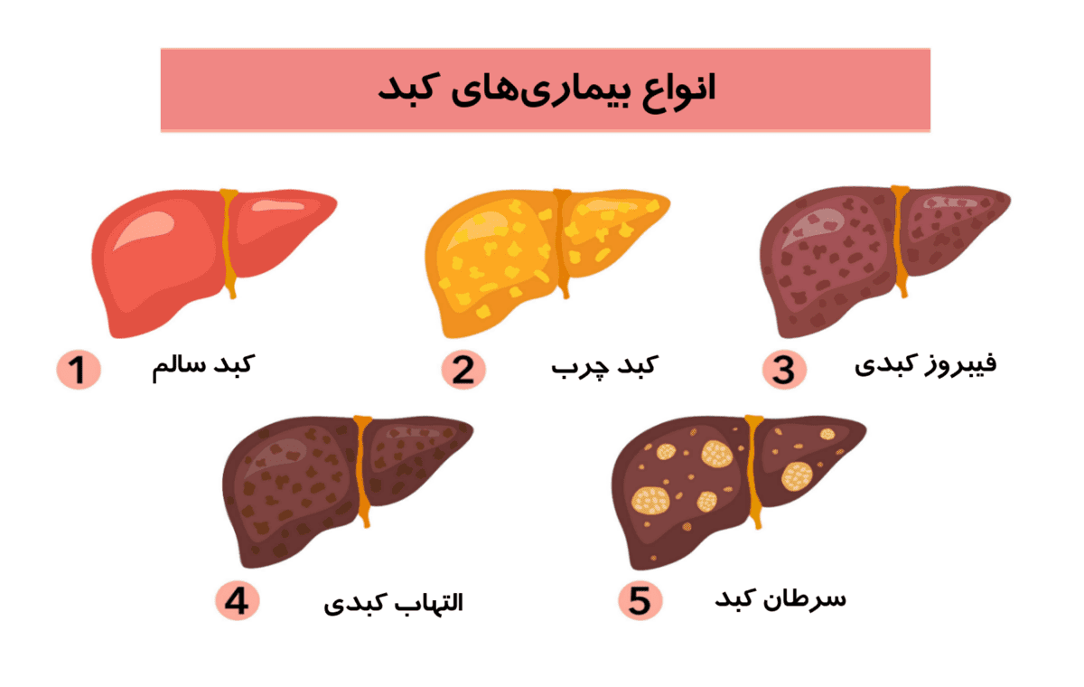 کبد چرب گرید ۳