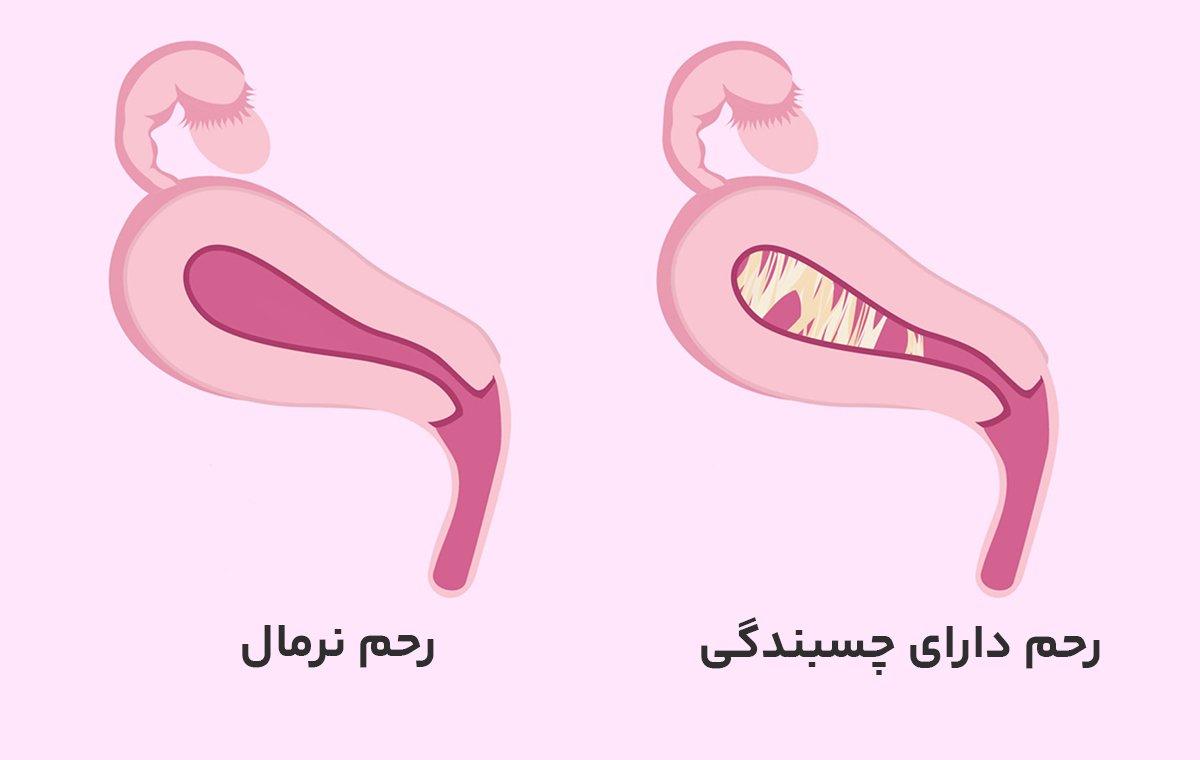 عکس چسبندگی رحم